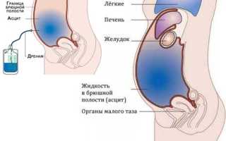 Прогноз и последствия асцита брюшной полости. Асцит брюшной полости — симптомы и варианты лечения, прогноз для жизни Асцит прокол брюшной полости