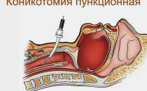 Коникотомия противопоказания. Коникотомия — техника выполнения и показания к операции