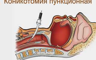 Коникотомия противопоказания. Коникотомия — техника выполнения и показания к операции