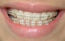 Дефекты зубных рядов. Обследование больных с частичными дефектами зубных рядов